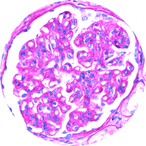 Mpgn Pattern Of Injury Graphic